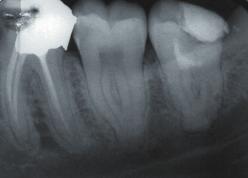 Figure 5: Postoperative radiograph showing pulpotomy with new endodontic material teeth. [5] Nyerere et al.