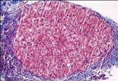 Stages of Fibrosis Batts-Ludwig (or a modified Ishak) Ishak Metavir 1 2 3 4 1 2 focal frequent 3 4