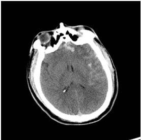 Traumatic SAH Scattered appearance Has a risk of vasospasm Less incidence