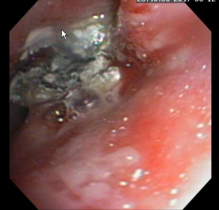 A fungal plaque (yellow/grey material) in the nasal passage of a dog with sinonasal aspergillosis Identification of Aspergillus spp.