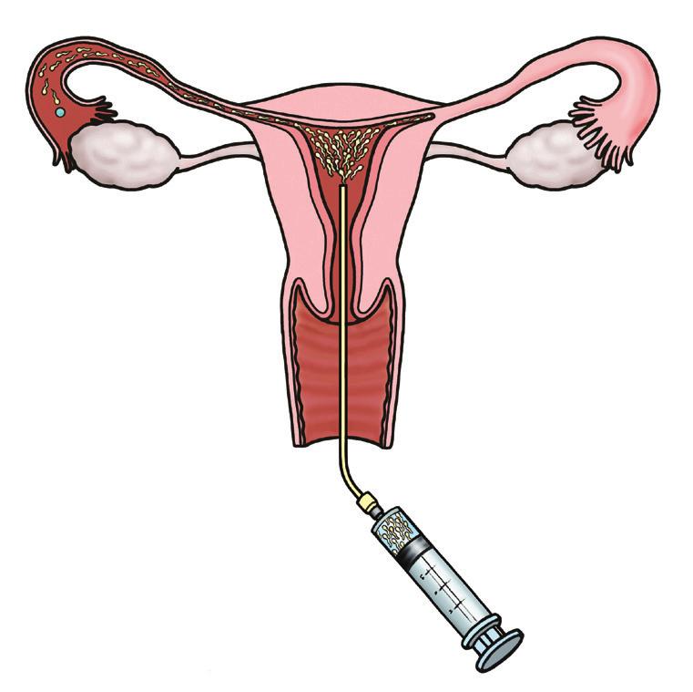What is intra-uterine insemination? Sometimes OI is combined with intra-uterine insemination. This is when sperm is put into the womb when ovulation has happened.