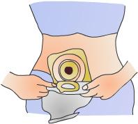 One Piece Pouch Pouches are either close-ended or open-ended. For example, patients with an ileostomy may benefit more from an open-ended pouch because they have more liquid stools.