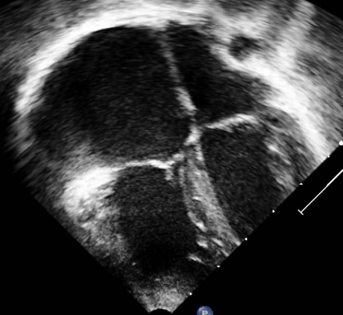 Imaging Echocardiography 4 chamber view, demonstrating right heart enlargement secondary to a