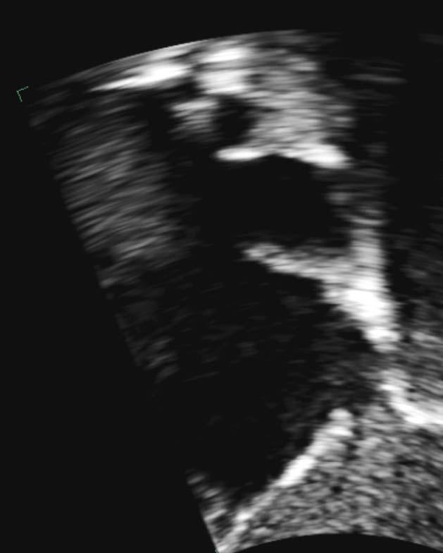 Imaging Echocardiography SVC PV LA RA Right-sided PAPVC draining into the proximal SVC