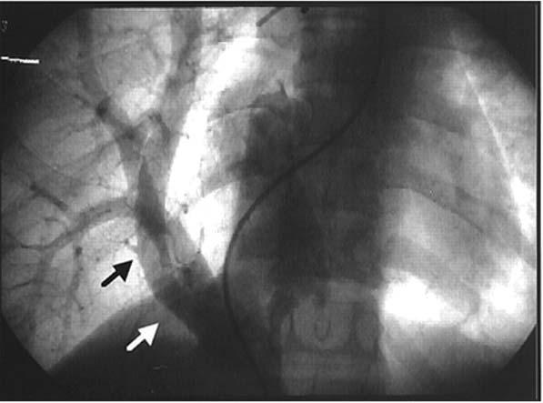 Cardiac catheterization Scimitar