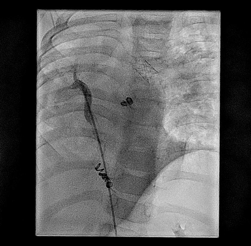 Cardiac catheterization Infantile form of scimitar syndrome with severe hypoplasia of right pulmonary artery, pulmonary
