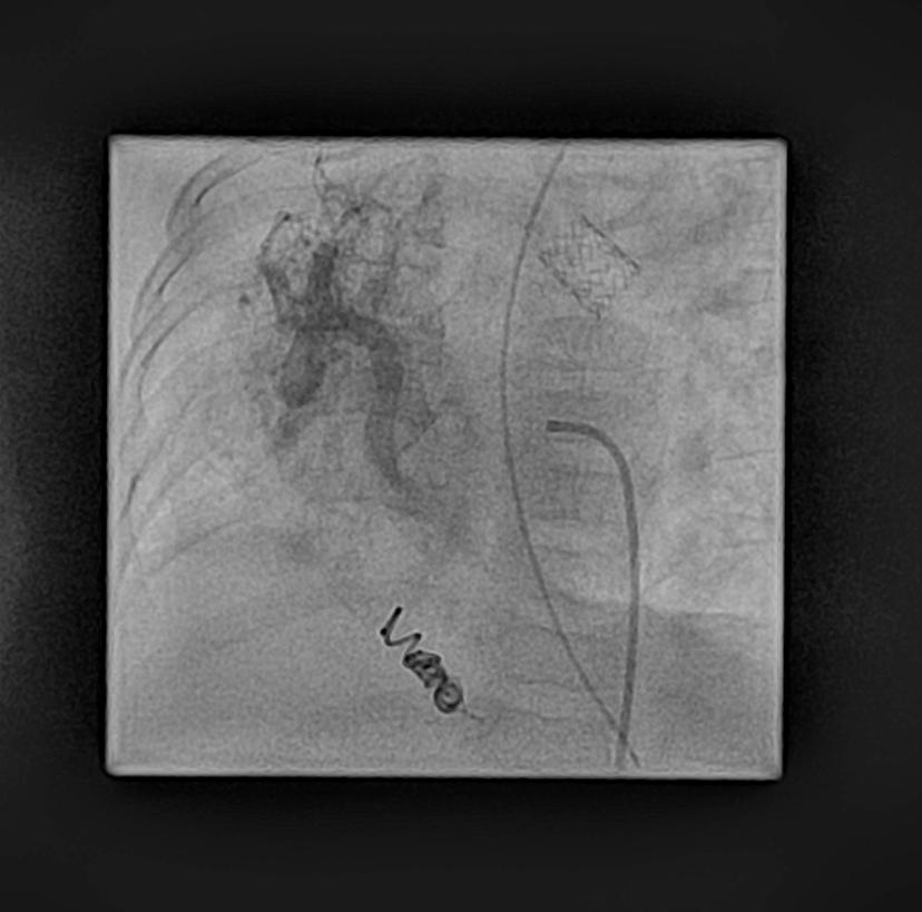 endobronchial stenting of left main bronchus Late phase of selective angiography of additional thoracic a-p collaterals