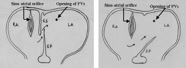 of the posterior and / or superior attachment of the septum primum resulting in right