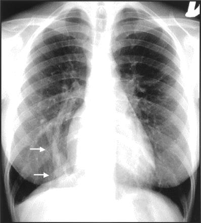 part or even the entire right lung