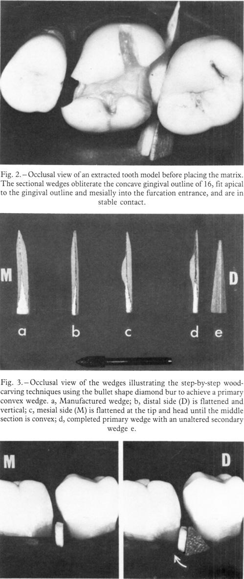 Fig. 2.-Occlusal view ofan extracted tooth model before placing the matrix.