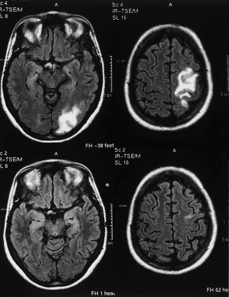 The role of seizures in reversible posterior leukoencephalopathy 279 Fig. 2: (a) FLAIR imaging showing high signal intensity lesions in the occipital and parietal area.