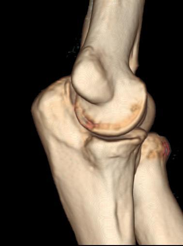 Medial collateral ligaments