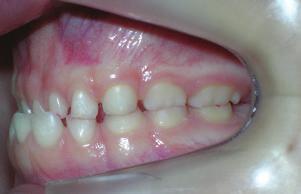It is recommended as a first measure to facilitate early treatment of posterior crossbite, producing wear on the occlusals to remove the occlusal