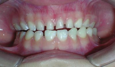 expansion or force during mandibular closing [8]. After application of Planas Direct Tracks, new grinds were made.
