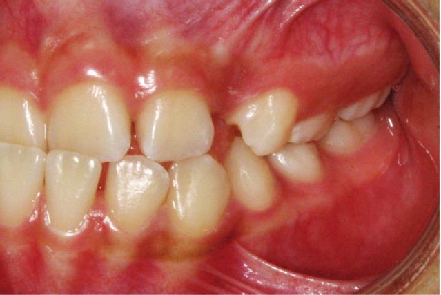 maxillary central and lateral incisors; crowding in both arches; and a lack