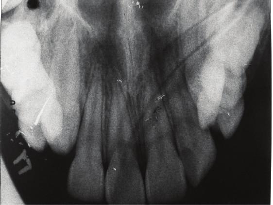 GoGn = 40, FMA = 29 ), protrusion of the mandibular incisors (IMPA = 99, 1.