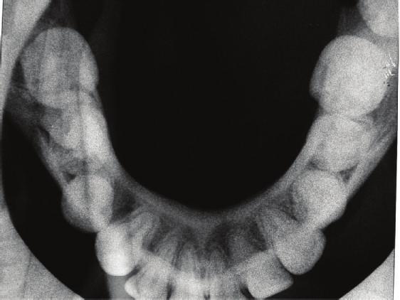 NA = 18, 1-NA = 1 mm), and protrusion of the lower lip (Ricketts E-line = 3