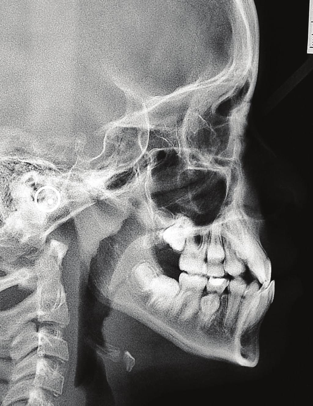 Case Reports in Dentistry 3 Figure 2: Lateral cephalogram radiograph.