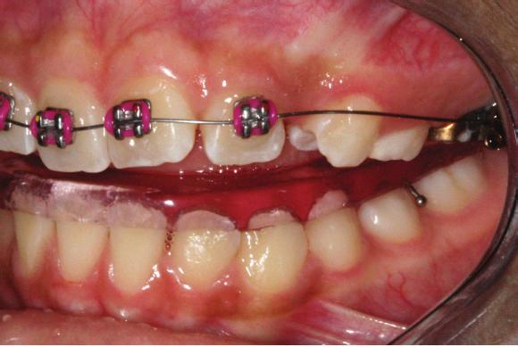 crossbite was attempted through maxillary expansion associated with a fixed 2 4 appliance.