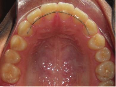 025 NiTi arch; the arch wire sequence in the mandibular