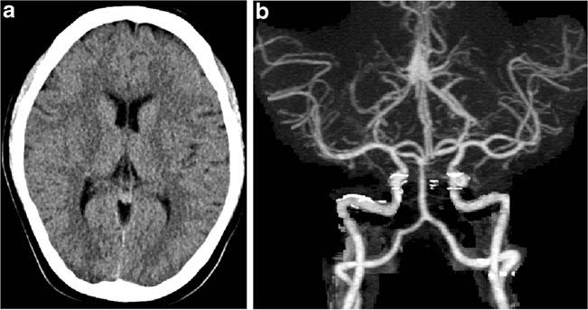 566 Emerg Radiol (2012) 19:565 569 Fig. 1 a Normal unenhanced head CT. b Maximum intensity projection image of the intracranial CTA revealing no stenosis agents due to concern for meningitis.