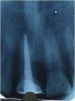 (figure 2,3). Figure 2- Pre-operative radiograph The patient was recalled after one week for the bleaching procedure.