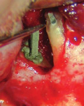 clinical report _ apical microsurgery series I Figs.