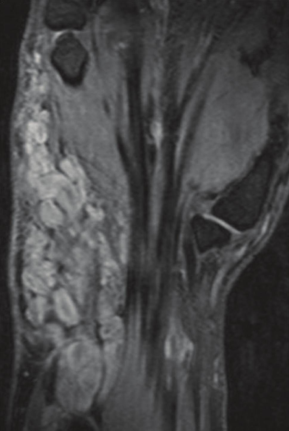 Case Reports in Radiology 3 FD (a) (b) Figure 3: Coronal T2-weighted wrist MRI with fat suppression (3a) anterior section: multilobulated mass abutting flexor digitorum longus (FD).