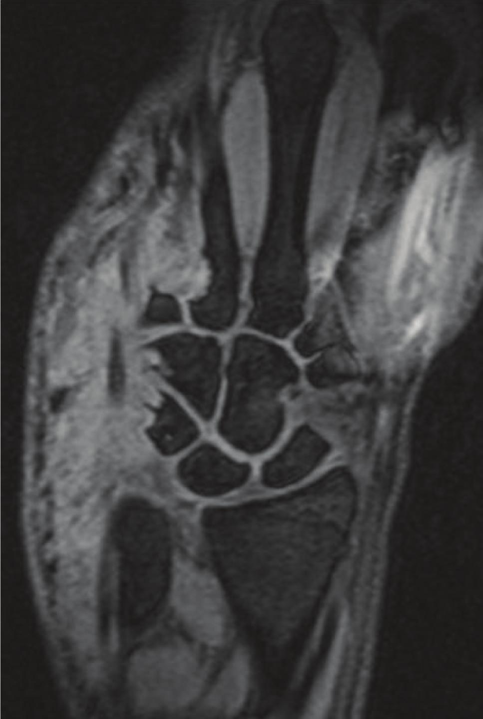 Figure 4: Ultrasound of the wrist conglomerate multilobulated lesions with target appearance (white arrows): central hyperechogenicity with hypoechoic periphery.