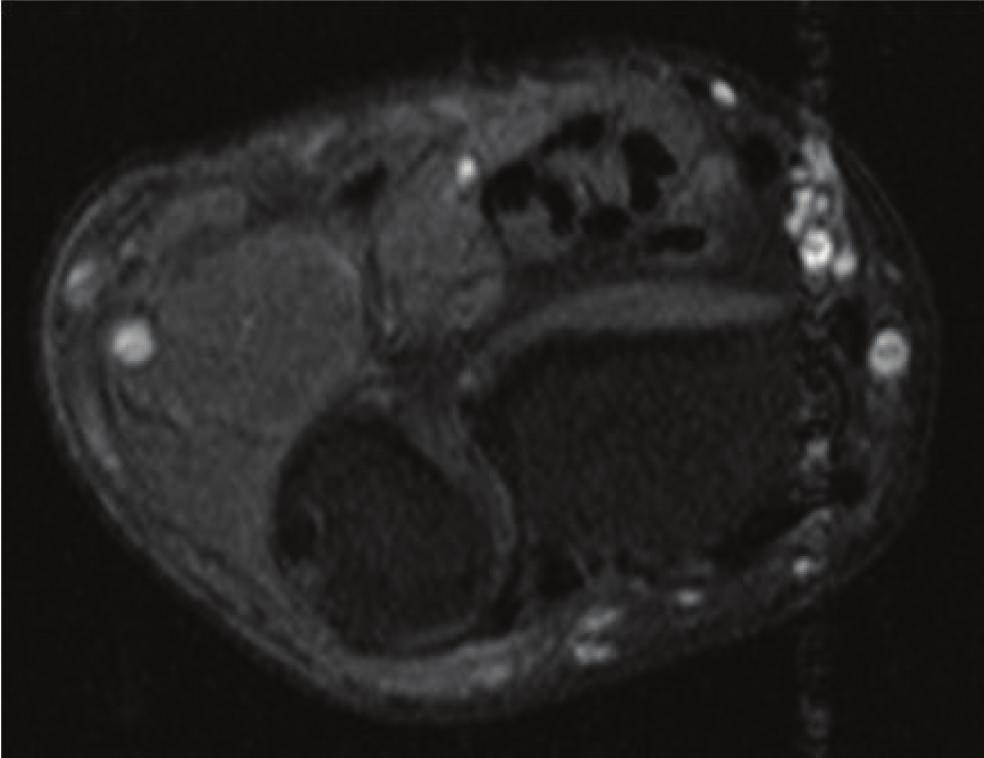 4 Case Reports in Radiology DR (a) (b) Figure 5: Axial T1-weighted wrist MRI with fat suppression (5a) precontrast, (5b) postcontrast: the majority of the lesion (seen more clearly on T2-weighted