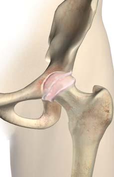 joint surfaces. This eventually results in bone-on-bone contact, producing pain and stiffness. Rheumatoid arthritis is a systemic disease that may attack any or all joints in the body.