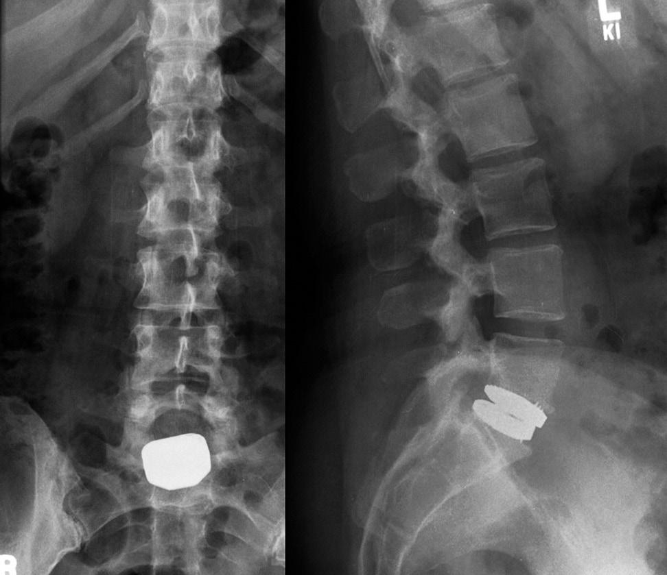 16 Hussein Alahmadi et al. Asian Spine J 2014;8(1):13-18 underwent a diagnostic discogram which provoked pain at L5 S1. The patient failed conservative measures.