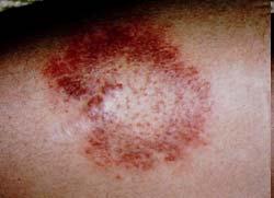 Rash Associated with Lyme Disease Tick Removal http://www.aafp.org/afp/20020815/643.