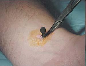 Tick Removal Tick Removal Ineffective or Dangerous Methods of Removing Ticks: Do not use sharp forceps. Do not crush, puncture, or squeeze the tick's body.