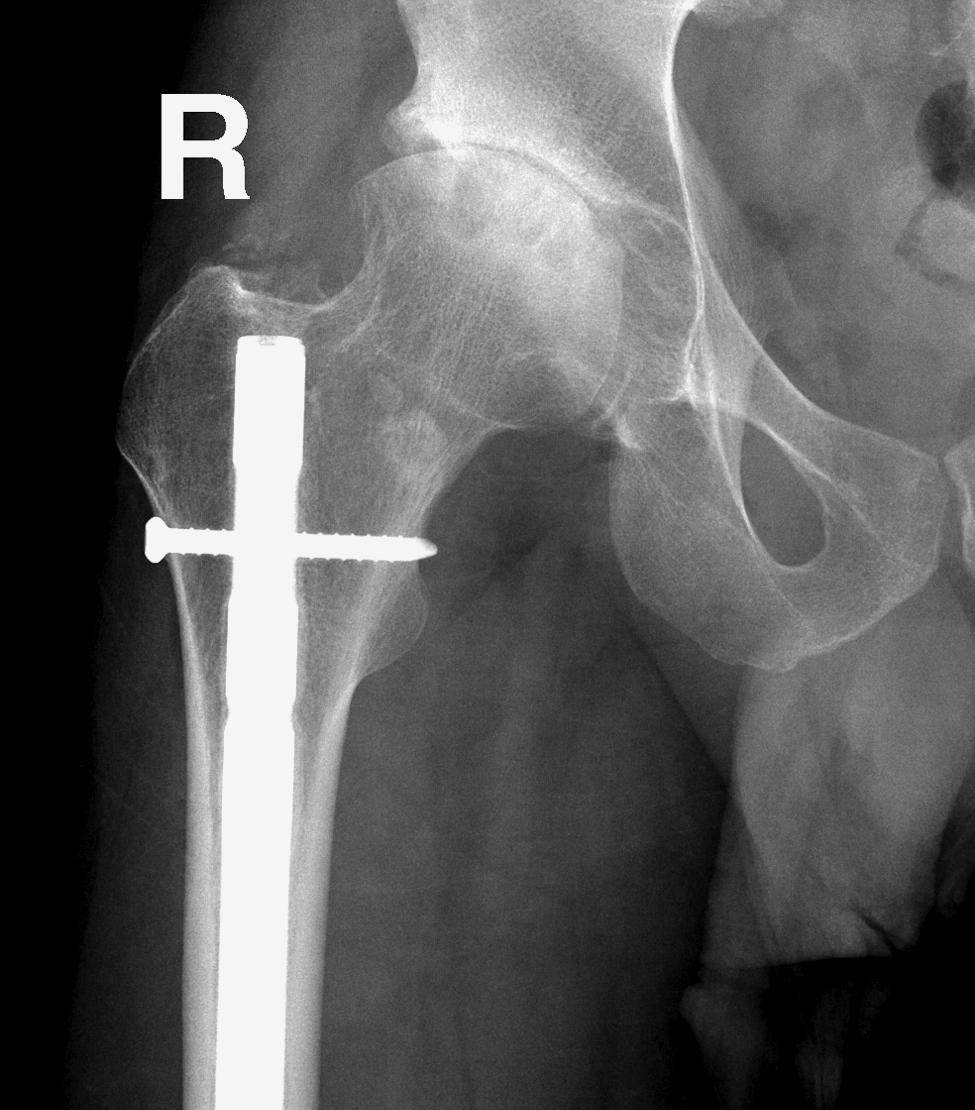 A S99 B Figure 1 Case 1. A, Anteroposterior radiograph taken 8 years post-exchange nailing and just prior to resurfacing. B, 13 months after resurfacing.