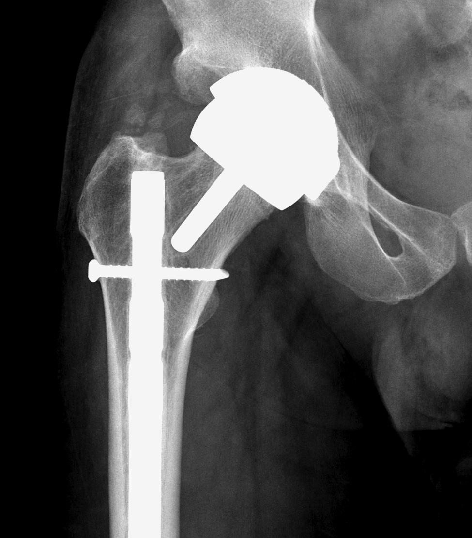 However, due to the location of the fracture, it was decided that appropriate management would be a staged ORIF of the fracture, using a dynamic condylar screw.