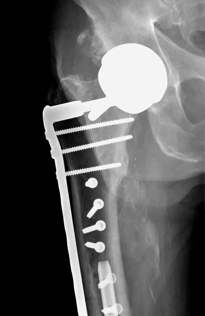 Arguments supporting hardware removal contend that hardware retention might lead to implant-related pain, metal sensitivity, carcinogenesis, and peri-implant fracture.