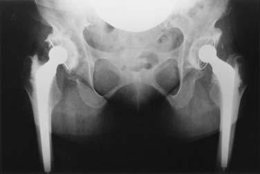 Then, an all-polyethylene acetabular cup (Stryker, USA) was cemented into the reamed-out femoral head since the head itself was thought to be too stiff to achieve a firm bond.