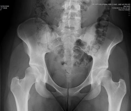Defining the underlying problem HIP PAIN 17 y.