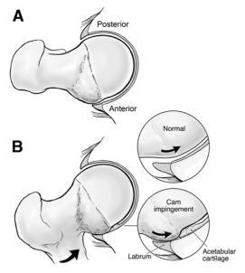 Hip Pain The Labrum Labral Tears Repetitive hip flexion or pivoting Skeletal deformities Femoroacetabular Impingement (FAI) Abnormal morphology + abnormal contact during terminal motion Hip pain and