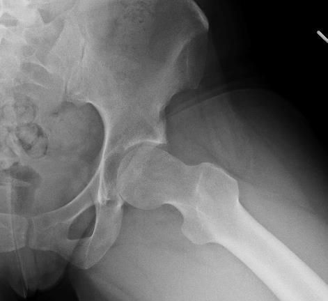 FAI Radiographs FAI 3D CT Development Dysplasia of the Hip