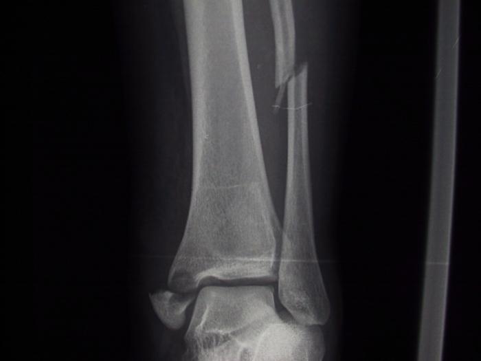 Literature 94 patients with ankle fractures 4 observers Classify according to Lauge Hansen and