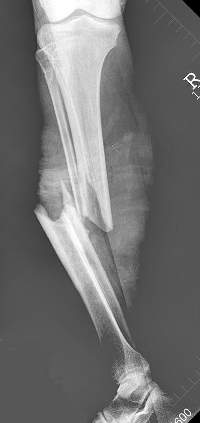 Literature Prospective study Tibial shaft fractures treated by