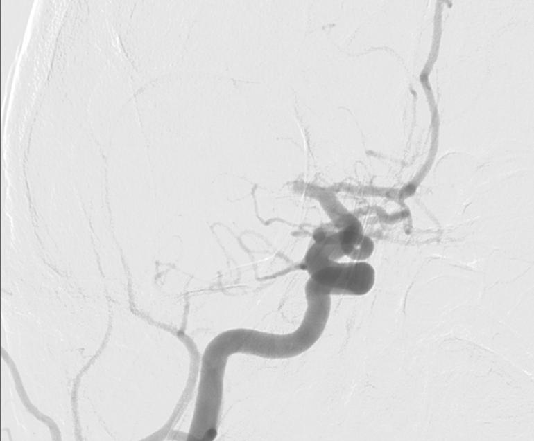 Endovascular Therapy for Acute Ischaemic Stroke in Northern Ireland Ian