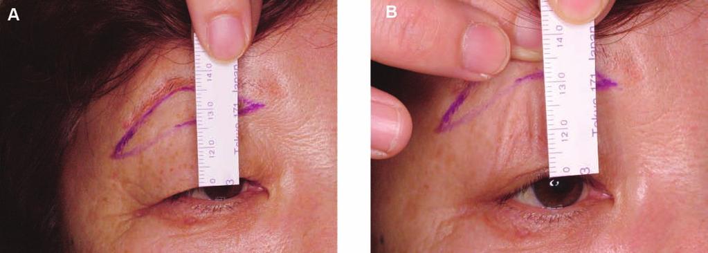 172 Aesthetic Surgery Journal 31(2) Figure 1. (A) A tape measure is fixed to the double eyelid line.