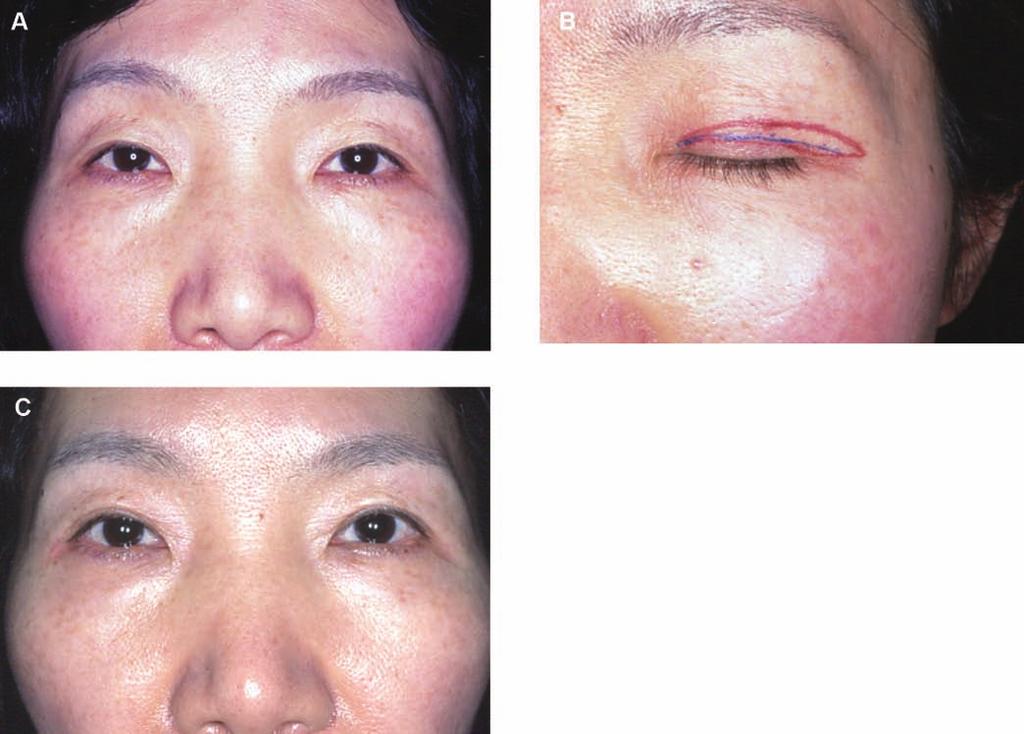Takayanagi 173 Figure 3. (A) This 51-year-old woman presented with a concern of overlying eyelid skin above her double eyelid crease. Her diagnosis was dermatochalasis of the upper eyelids.