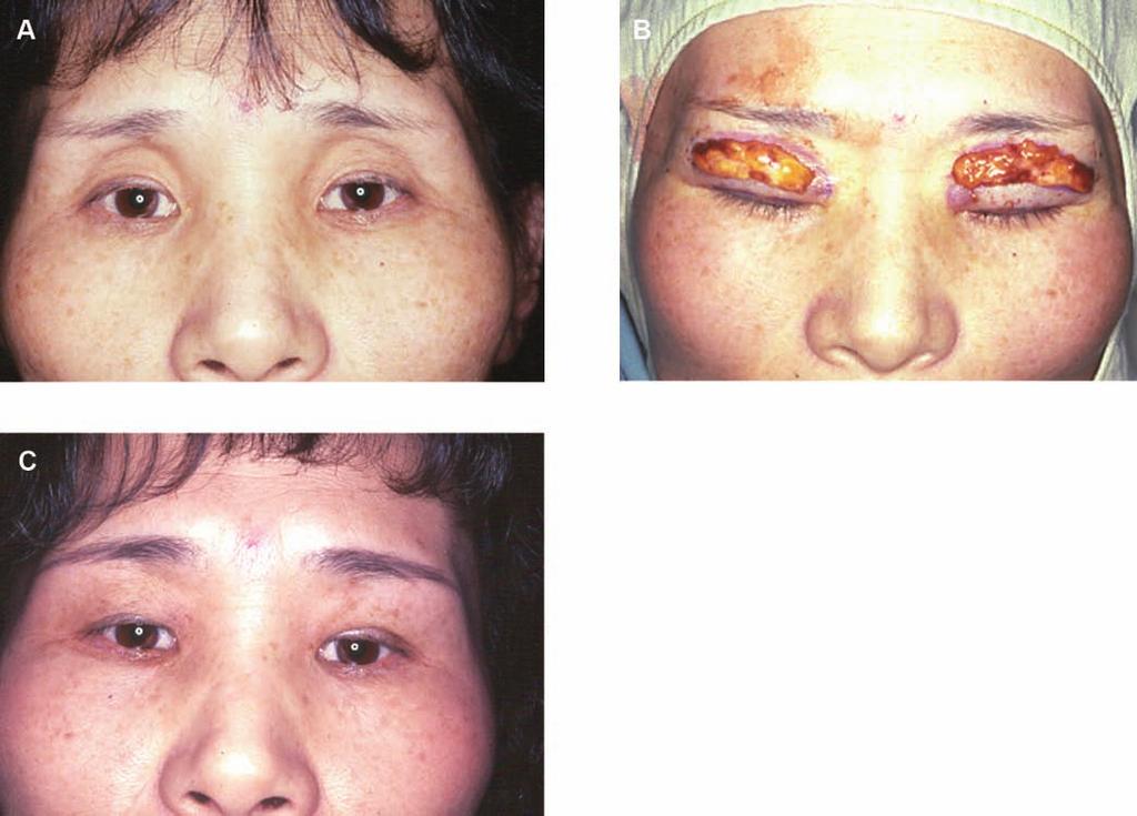 The double eyelid incision pushed the patient s skin forward and corrected the sunken eyelid. Figure 12. (A) This 59-year-old woman presented with sunken eyelid deformity.