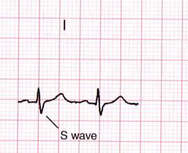 Acute Pulmonary Embolism ECG findings noted during the acute phase of pulmonary embolism can include any
