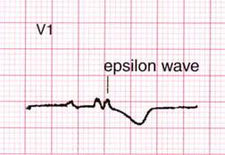 Features of this EKG SR w/1 0 AVB,