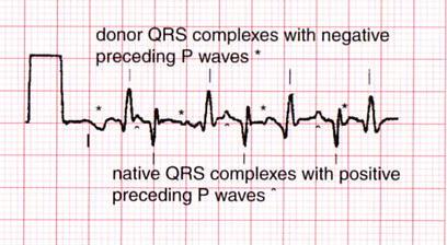 anterolateral MI with deep Q-waves in